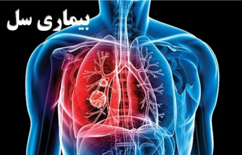 خطر ابتلا به سل در هرمزگان وجود دارد